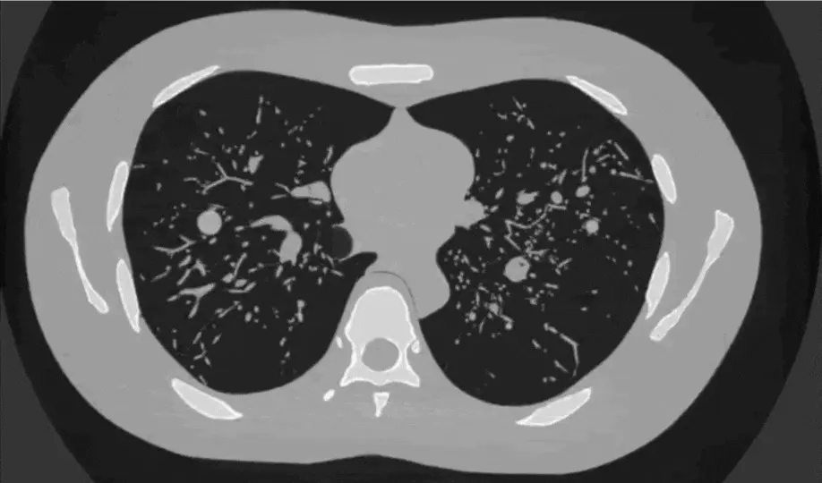 CT reconstruction of the LungMan phantom